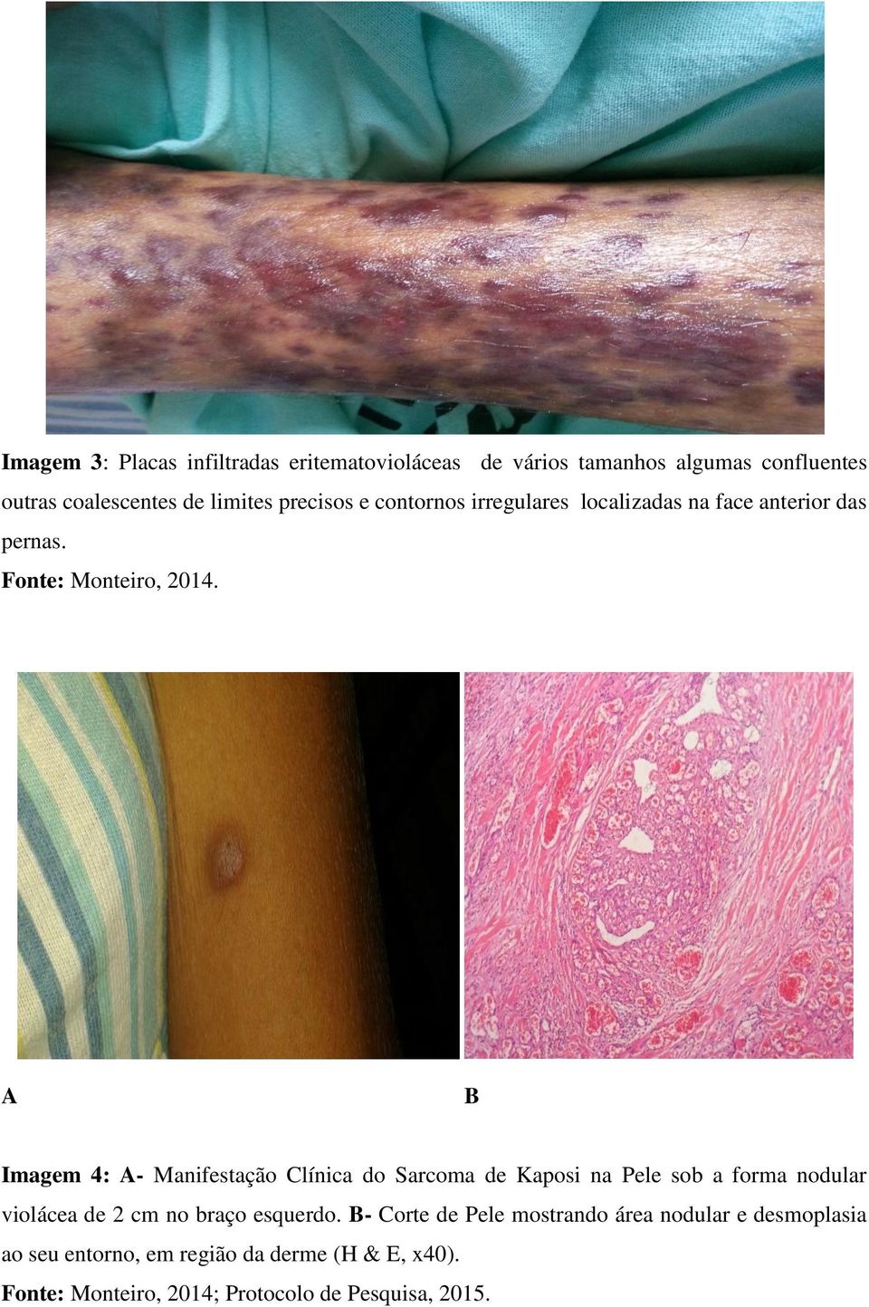 A B Imagem 4: A- Manifestação Clínica do Sarcoma de Kaposi na Pele sob a forma nodular violácea de 2 cm no braço esquerdo.