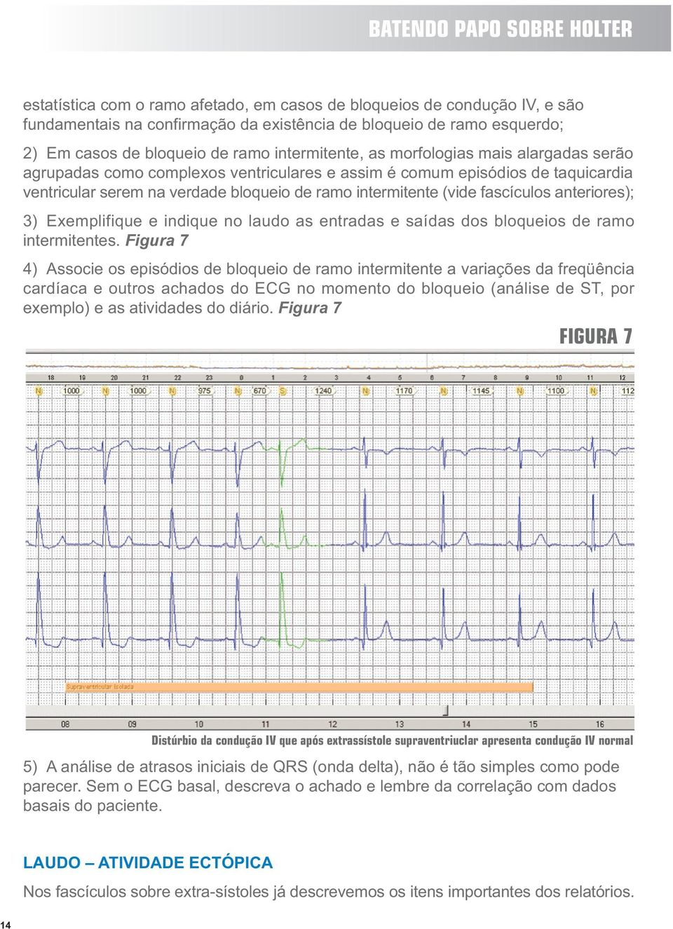 anteriores); 3) Exemplifique e indique no laudo as entradas e saídas dos bloqueios de ramo intermitentes.