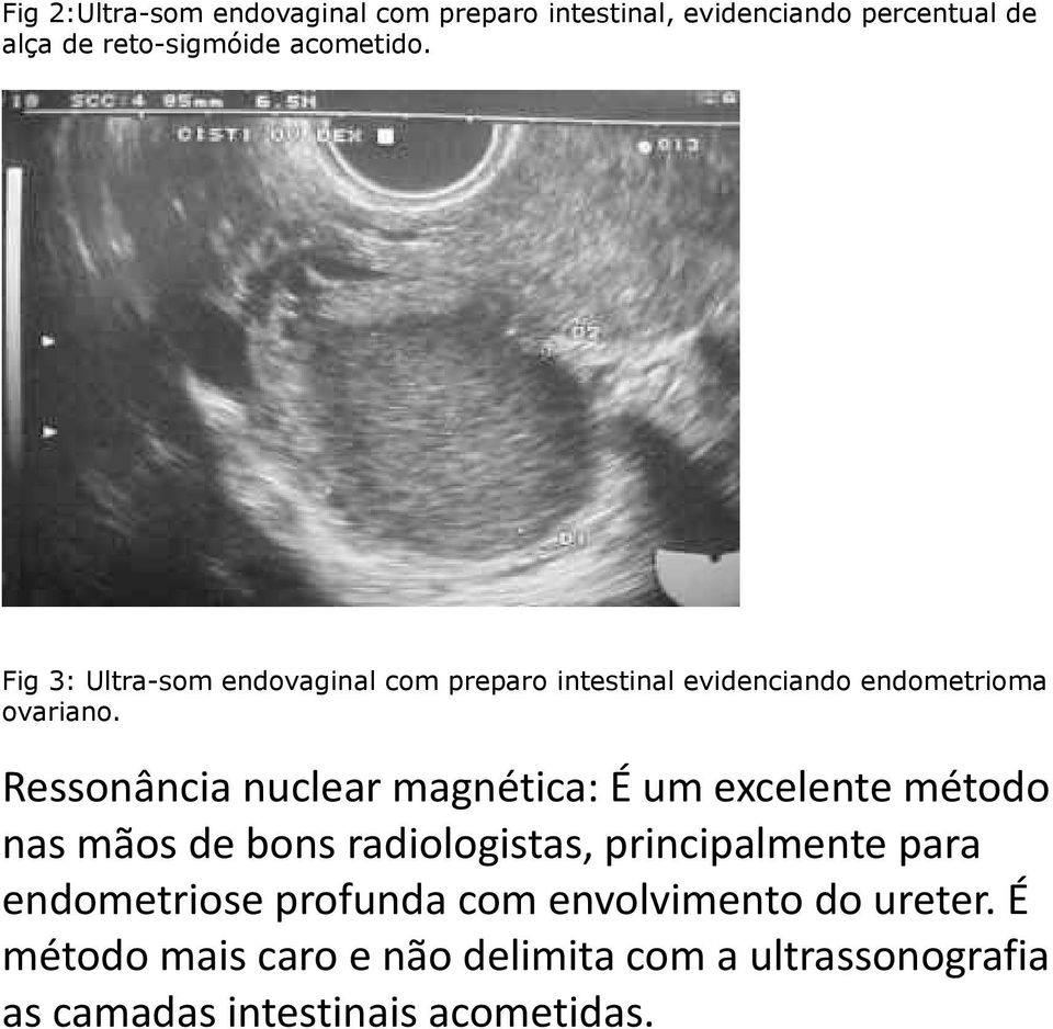 Ressonância nuclear magnética: É um excelente método nas mãos de bons radiologistas, principalmente para