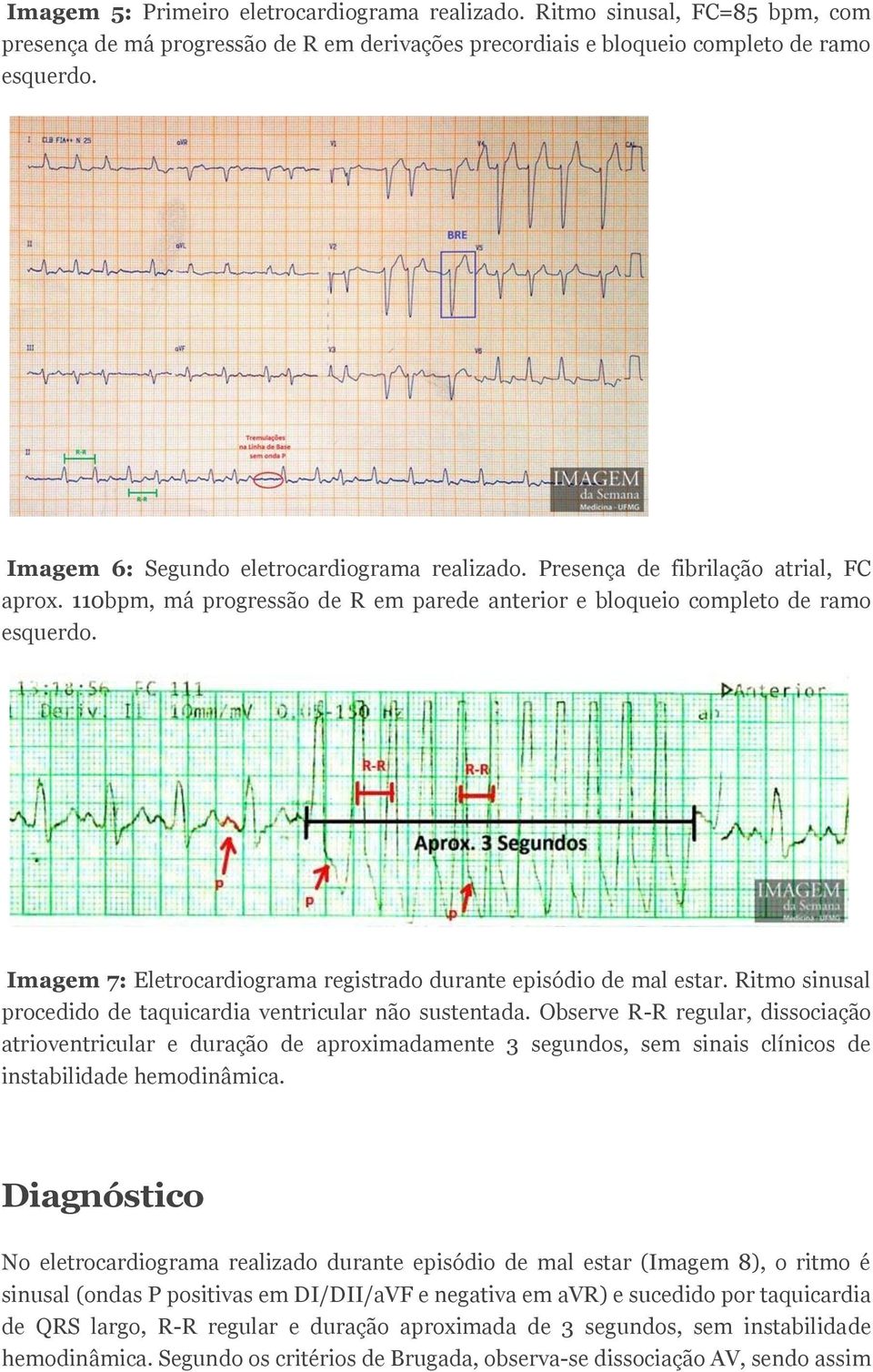 Imagem 7: Eletrocardiograma registrado durante episódio de mal estar. Ritmo sinusal procedido de taquicardia ventricular não sustentada.