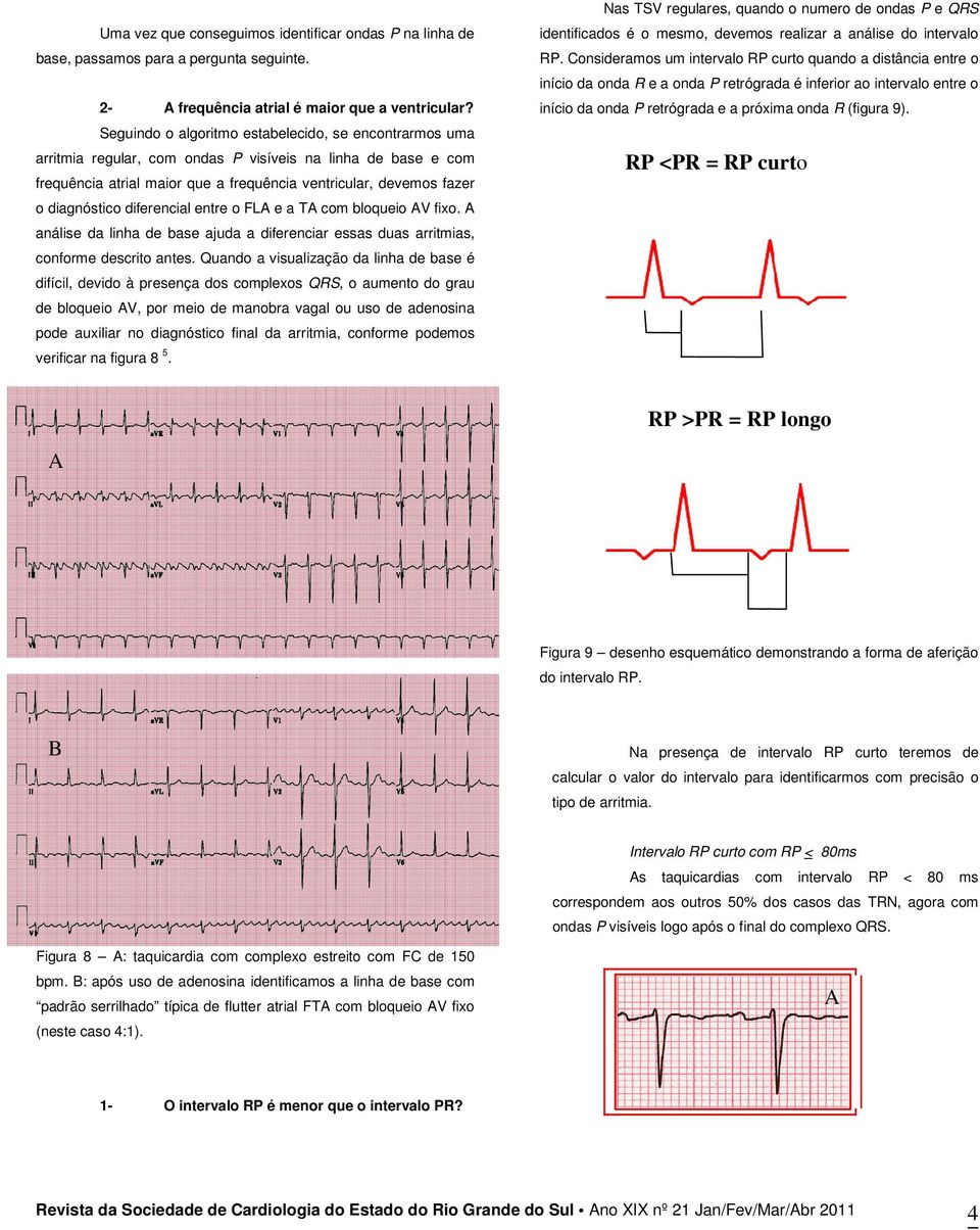 Consideramos um intervalo RP curto quando a distância entre o início da onda R e a onda P retrógrada é inferior ao intervalo entre o 2- frequência atrial é maior que a ventricular?