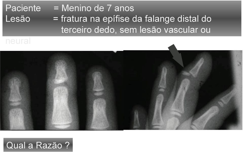 terceiro dedo, sem lesão vascular ou