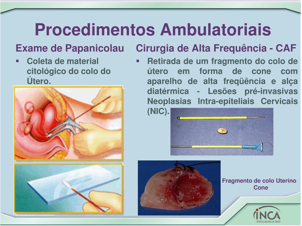 Cirurgia de Alta Frequência - CAF Retirada de um fragmento do colo de útero em forma