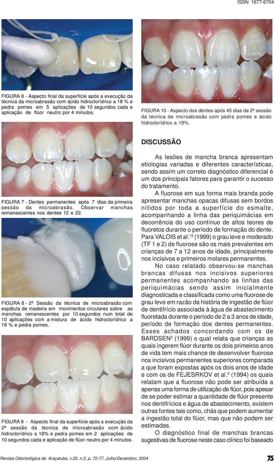 DISCUSSÃO FIGURA 7 - Dentes permanentes após 7 dias da primeira sessão da microabrasão. Observar manchas remanescentes nos dentes 12 e 22.