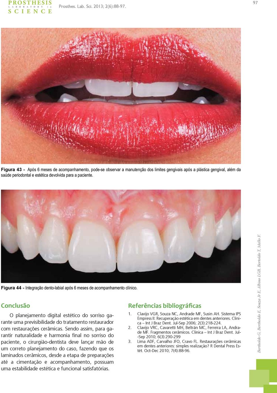 Figura 44 - Integração dento-labial após 6 meses de acompanhamento clínico.