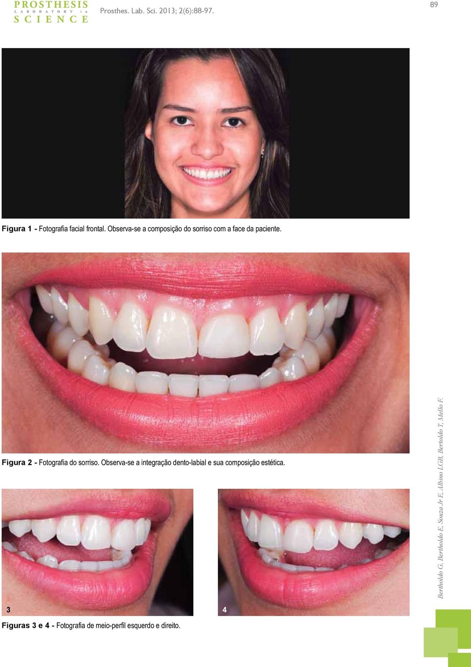 Figura 2 - Fotografia do sorriso. Observa-se a integração dento-labial e sua composição estética.