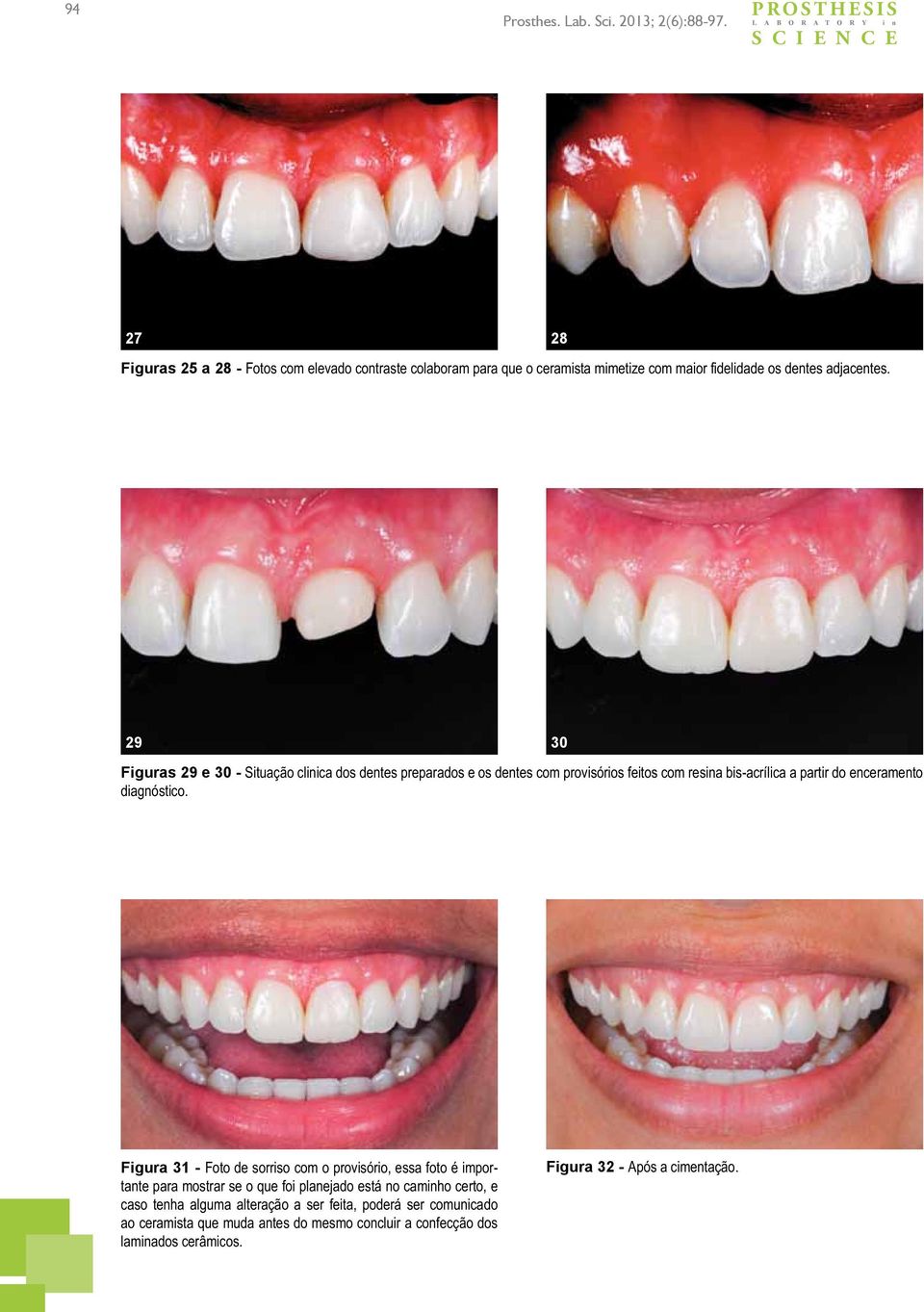 28 29 Figuras 29 e 30 - Situação clinica dos dentes preparados e os dentes com provisórios feitos com resina bis-acrílica a partir do enceramento diagnóstico.