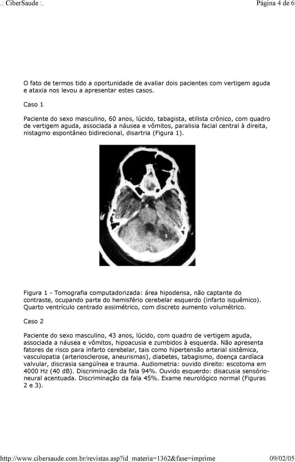 bidirecional, disartria (Figura 1). Figura 1 - Tomografia computadorizada: área hipodensa, não captante do contraste, ocupando parte do hemisfério cerebelar esquerdo (infarto isquêmico).