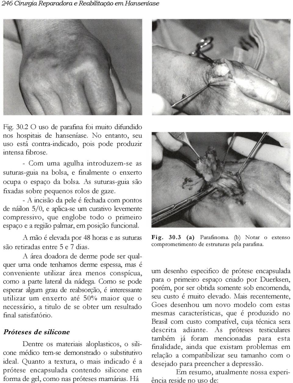 As suturas-guia são fixadas sobre pequenos rolos de gaze.