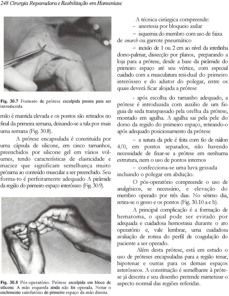 resi-dual do primeiro interósseo e do adutor do polegar, entre os quais deverá ficar alojada a prótese Fig. 30.7 Formato de prótese esculpida pronta para ser introduzida.