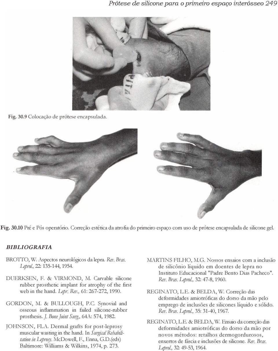 Carvable silicone rubber prosthetic implant for atrophy of the first web in the hand. Lepr. Rev., 61: 267-272, 1990. GORDON, M. & BULLOUGH, P.C. Synovial and osseous inflammation in failed silicone-rubber prosthesis.