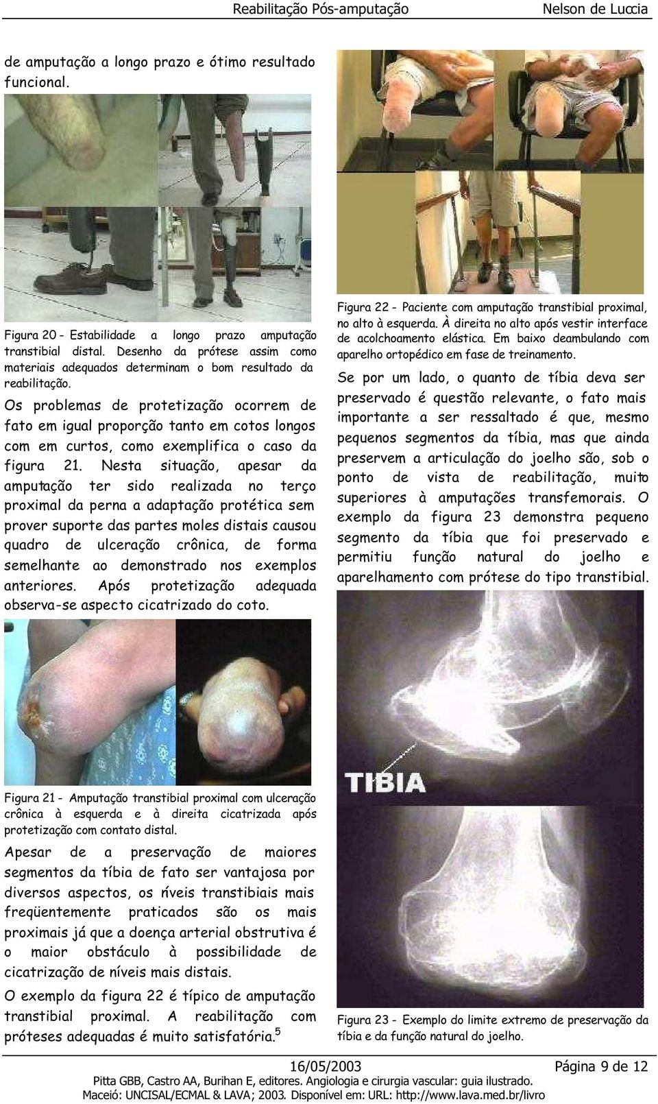 Os problemas de protetização ocorrem de fato em igual proporção tanto em cotos longos com em curtos, como exemplifica o caso da figura 21.