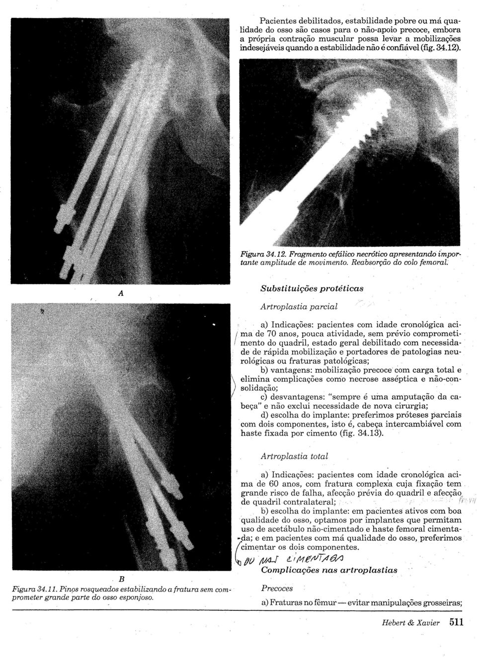 A Substituições protêticas Artroplastia parcial B Figura 34.11. Pinps rosqueados estabilizando a fratura sem com" prometer grande parte do osso esponjoso.