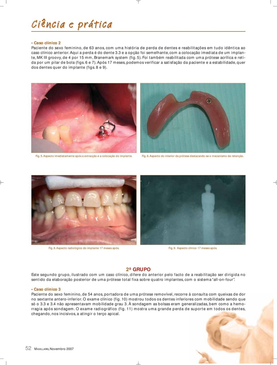 Foi também reabilitada com uma prótese acrílica e retida por um pilar de bola (figs. 6 e 7).