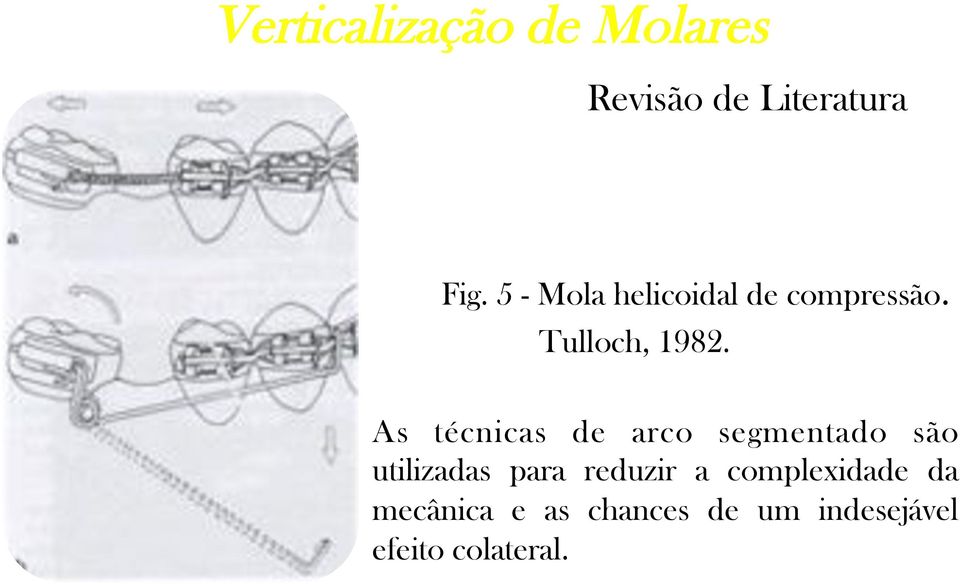 As técnicas de arco segmentado são utilizadas para