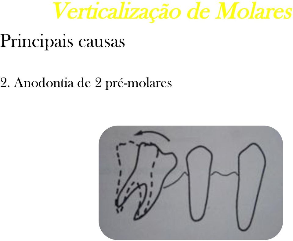 Anodontia