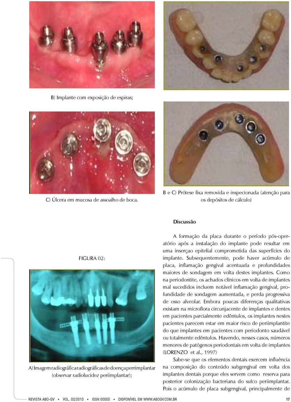 periimplantar); A formação da placa durante o período pós-operatório após a instalação do implante pode resultar em uma inserçao epitelial comprometida das superfícies do implante.