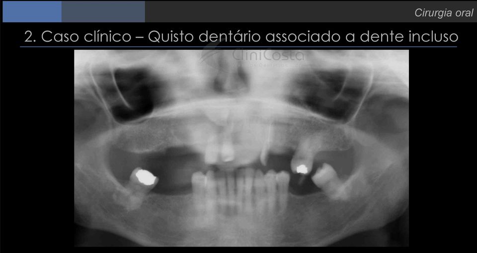 Quisto dentário