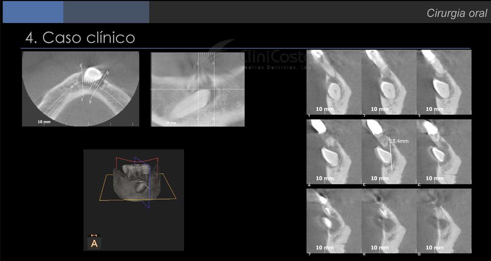 Caso clínico Oblique: Espessura = 00 µm Espaçamento =,0 mm Dose