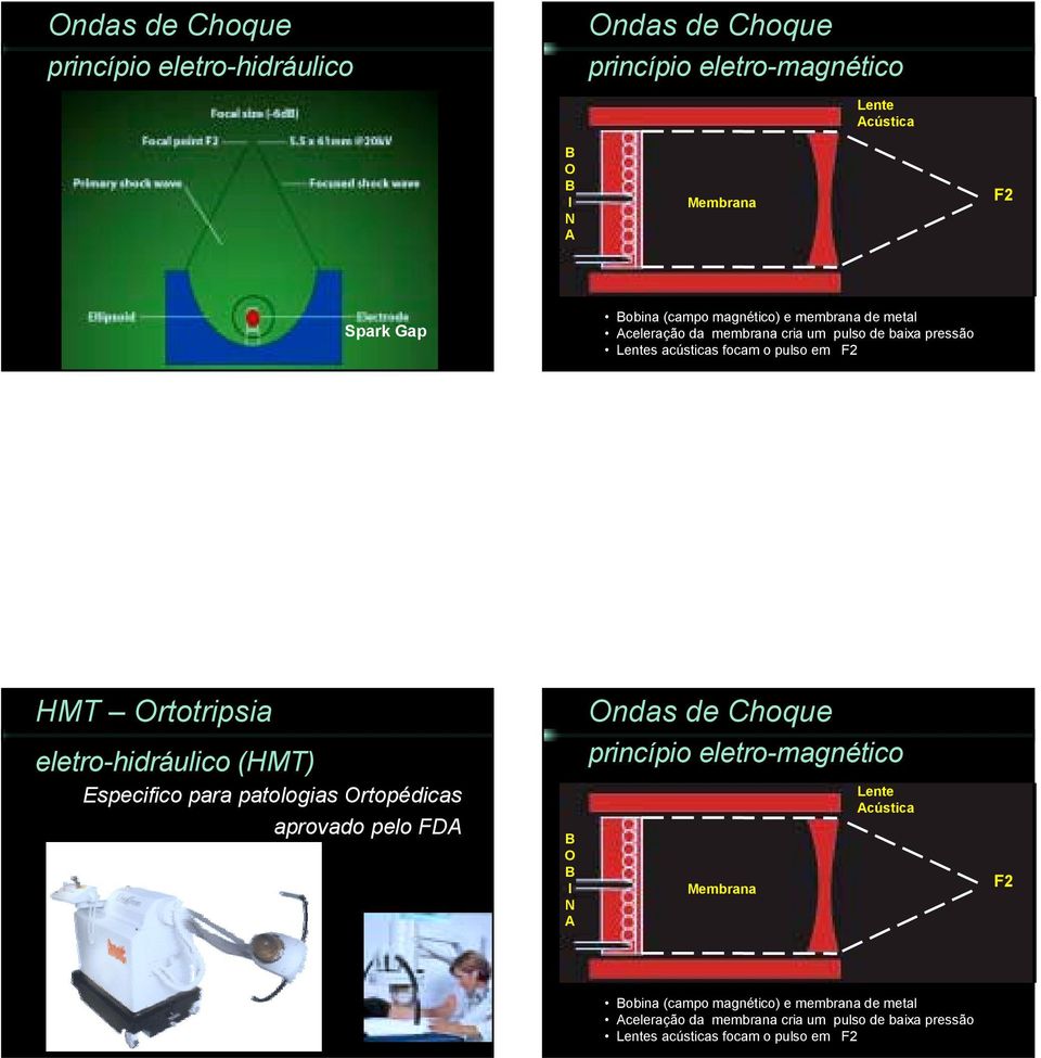 eletro-hidráulico (HMT) Especifico para patologias Ortopédicas aprovado pelo FDA B O B I N A princípio eletro-magnético Membrana Lente
