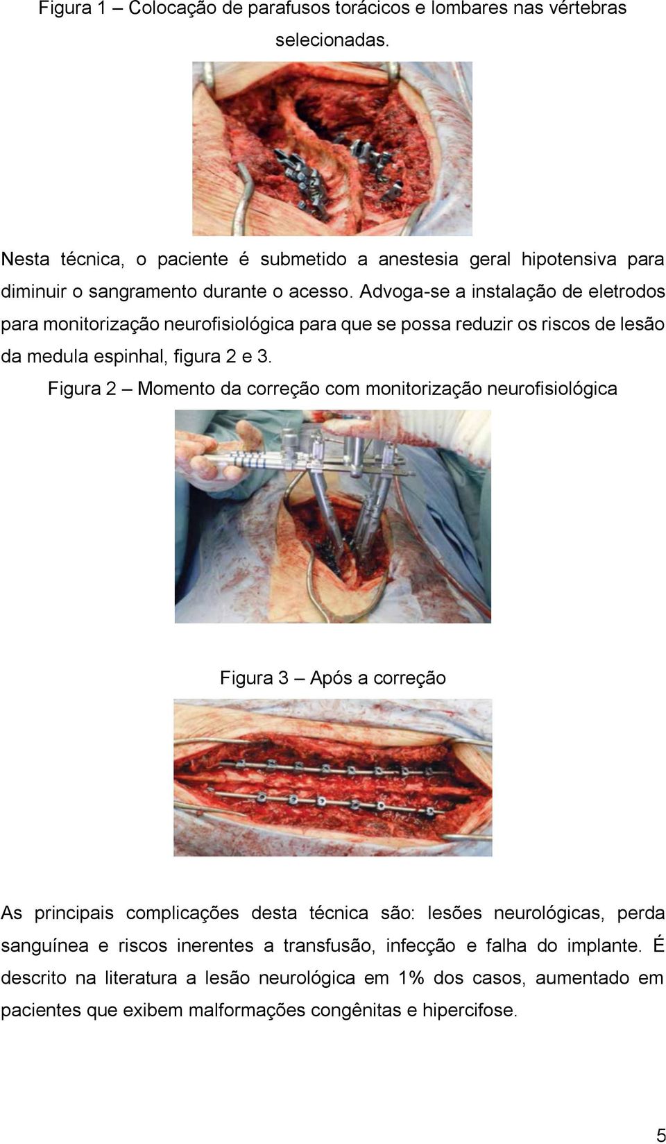 Advoga-se a instalação de eletrodos para monitorização neurofisiológica para que se possa reduzir os riscos de lesão da medula espinhal, figura 2 e 3.