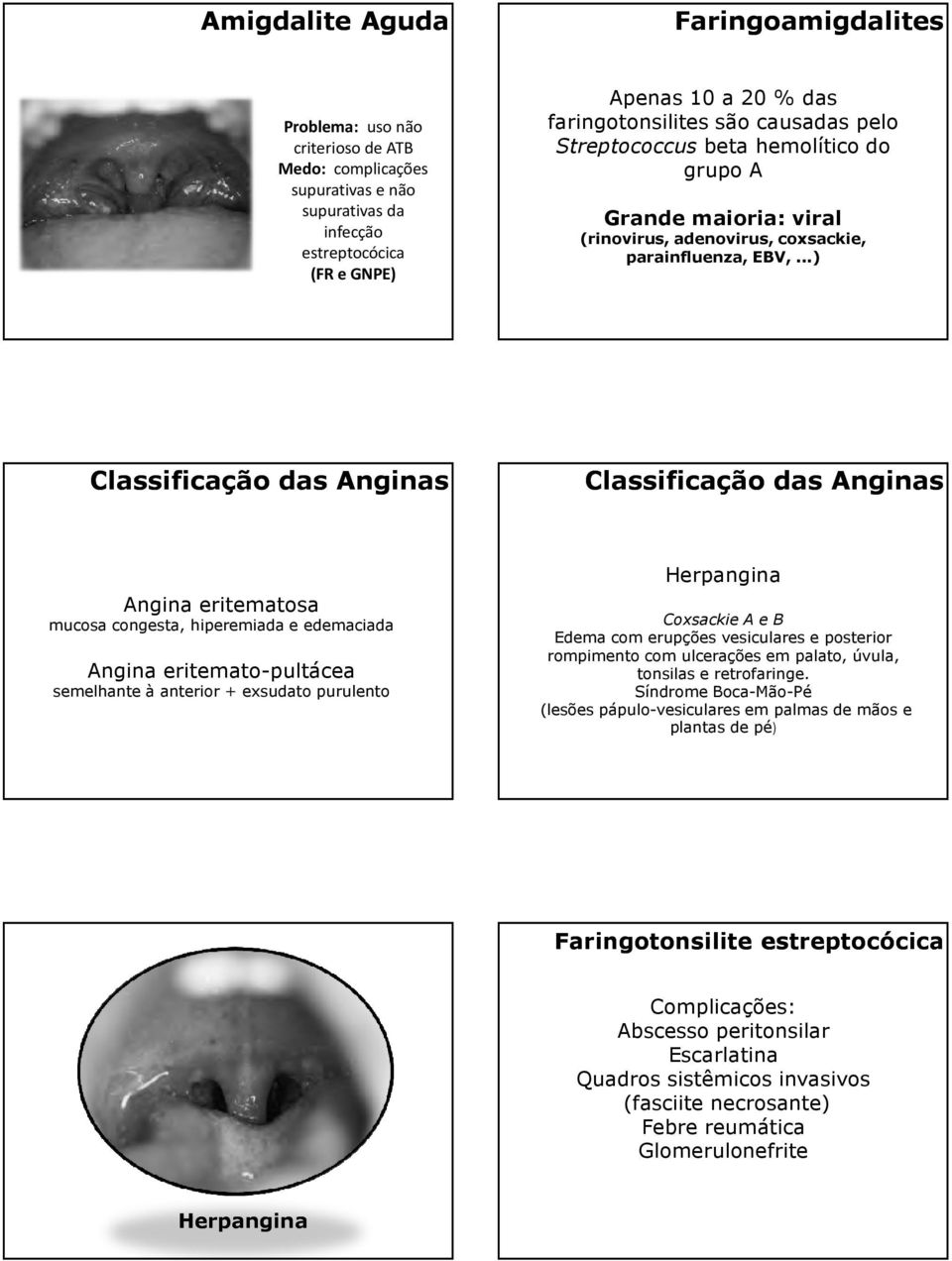 ..) Classificação das Anginas Classificação das Anginas Angina eritematosa mucosa congesta, hiperemiada e edemaciada Angina eritemato-pultácea semelhante à anterior + exsudato purulento Herpangina