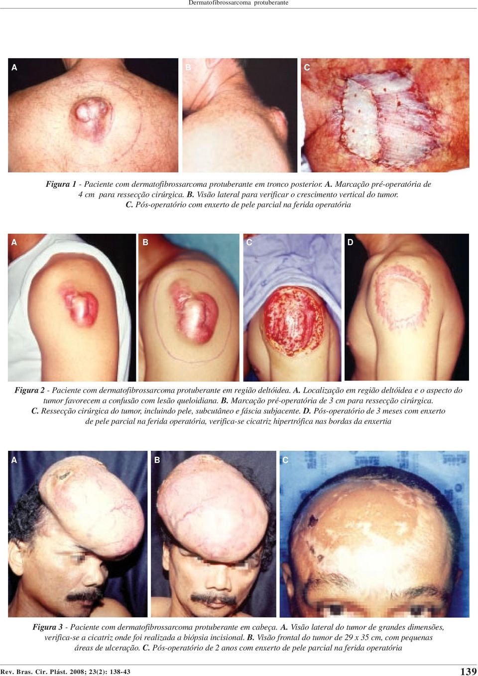 Pós-operatório com enxerto de pele parcial na ferida operatória D Figura 2 - Paciente com dermatofibrossarcoma protuberante em região deltóidea. A.