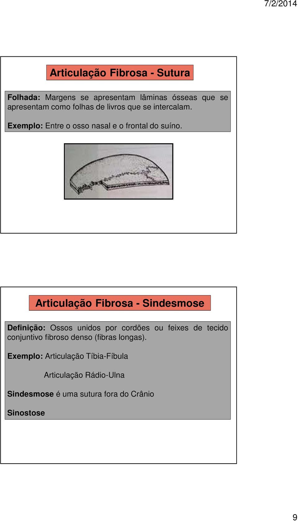 Articulação Fibrosa - Sindesmose Definição: Ossos unidos por cordões ou feixes de tecido conjuntivo