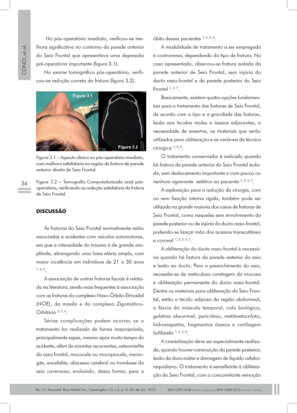 1 Aspecto clínico no pós-operatório imediato, com melhora satisfatória na região da fratura de parede anterior direita de Seio Frontal. Figura 3.