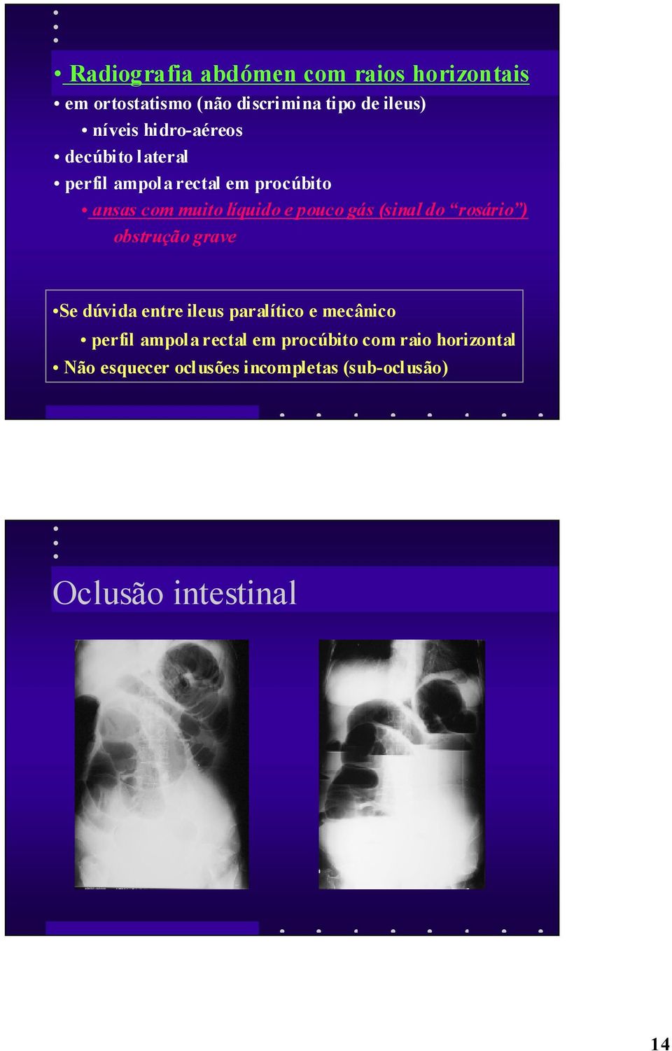 (sinal do rosário ) obstrução grave Se dúvida entre ileus paralítico e mecânico perfil ampola