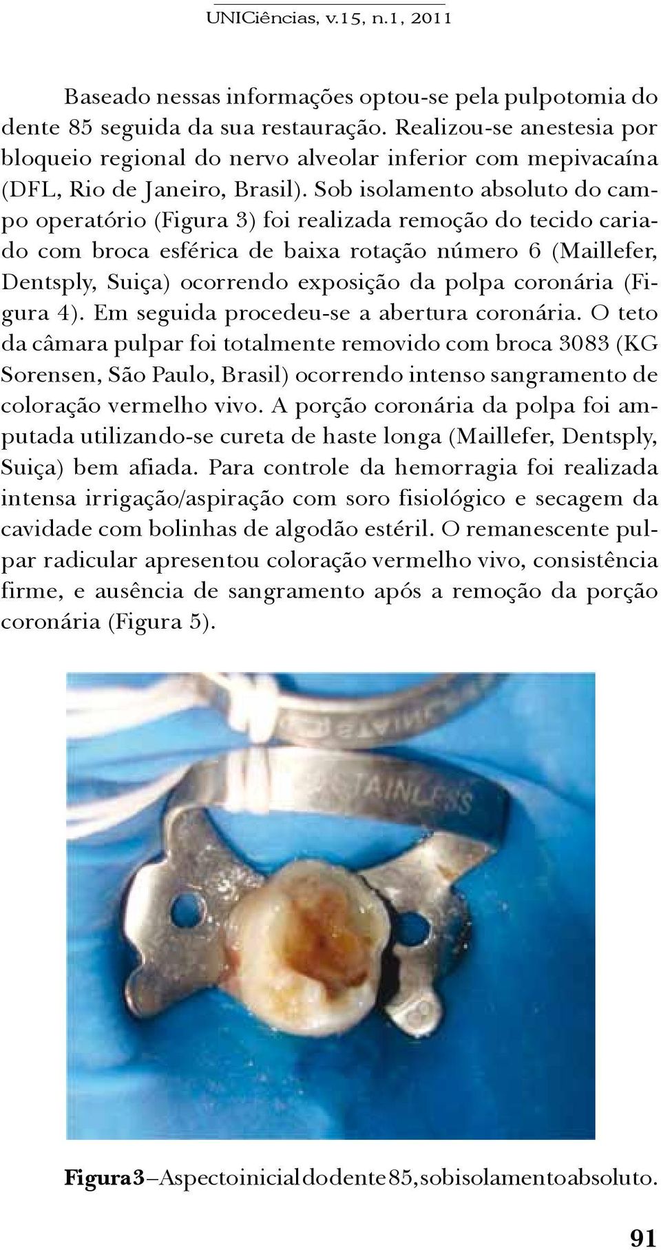 Sob isolamento absoluto do campo operatório (Figura 3) foi realizada remoção do tecido cariado com broca esférica de baixa rotação número 6 (Maillefer, Dentsply, Suiça) ocorrendo exposição da polpa