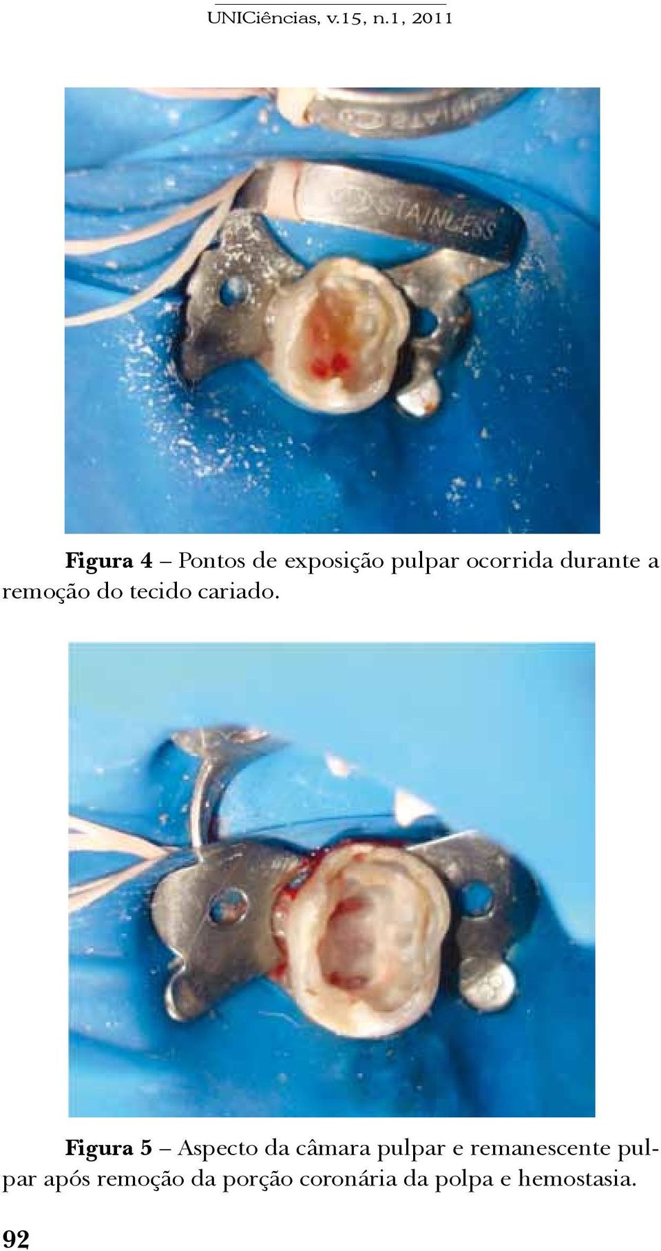 Figura 5 Aspecto da câmara pulpar e remanescente