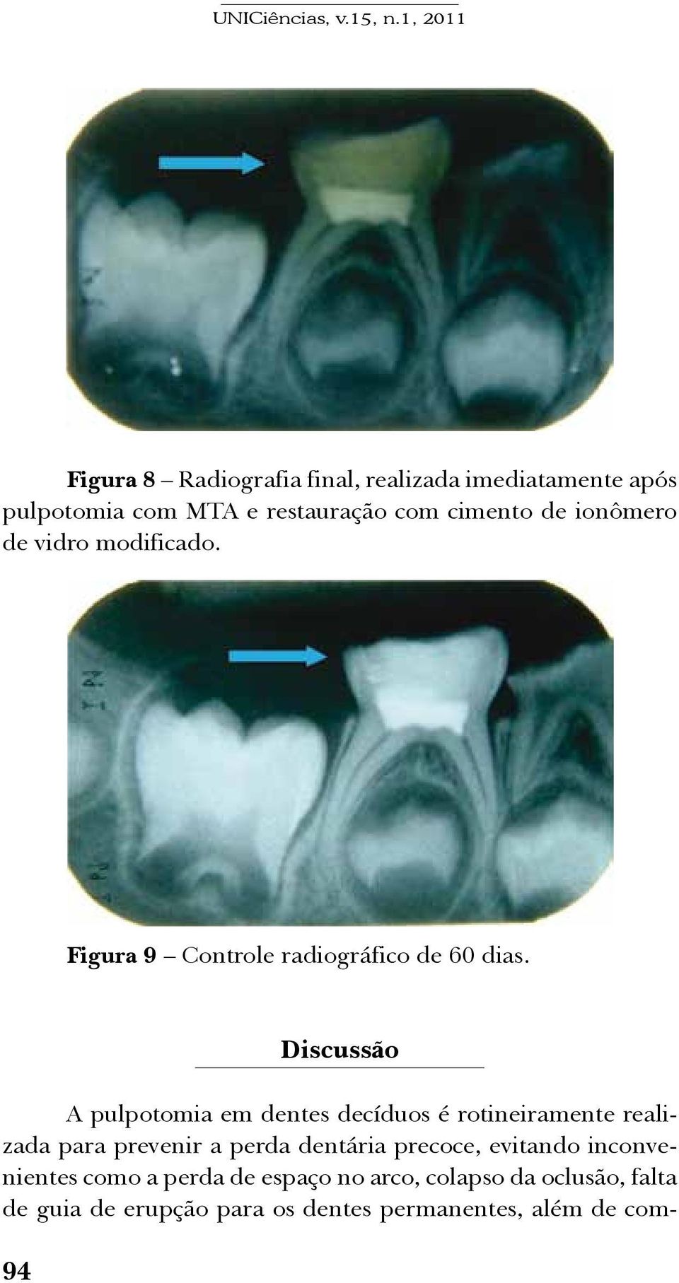 94 Discussão A pulpotomia em dentes decíduos é rotineiramente realizada para prevenir a perda dentária