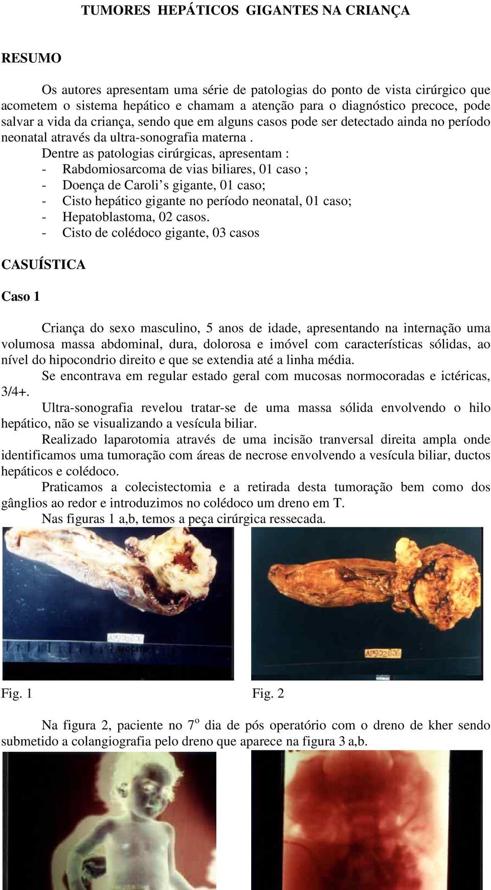 Dentre as patologias cirúrgicas, apresentam : - Rabdomiosarcoma de vias biliares, 01 caso ; - Doença de Caroli s gigante, 01 caso; - Cisto hepático gigante no período neonatal, 01 caso; -