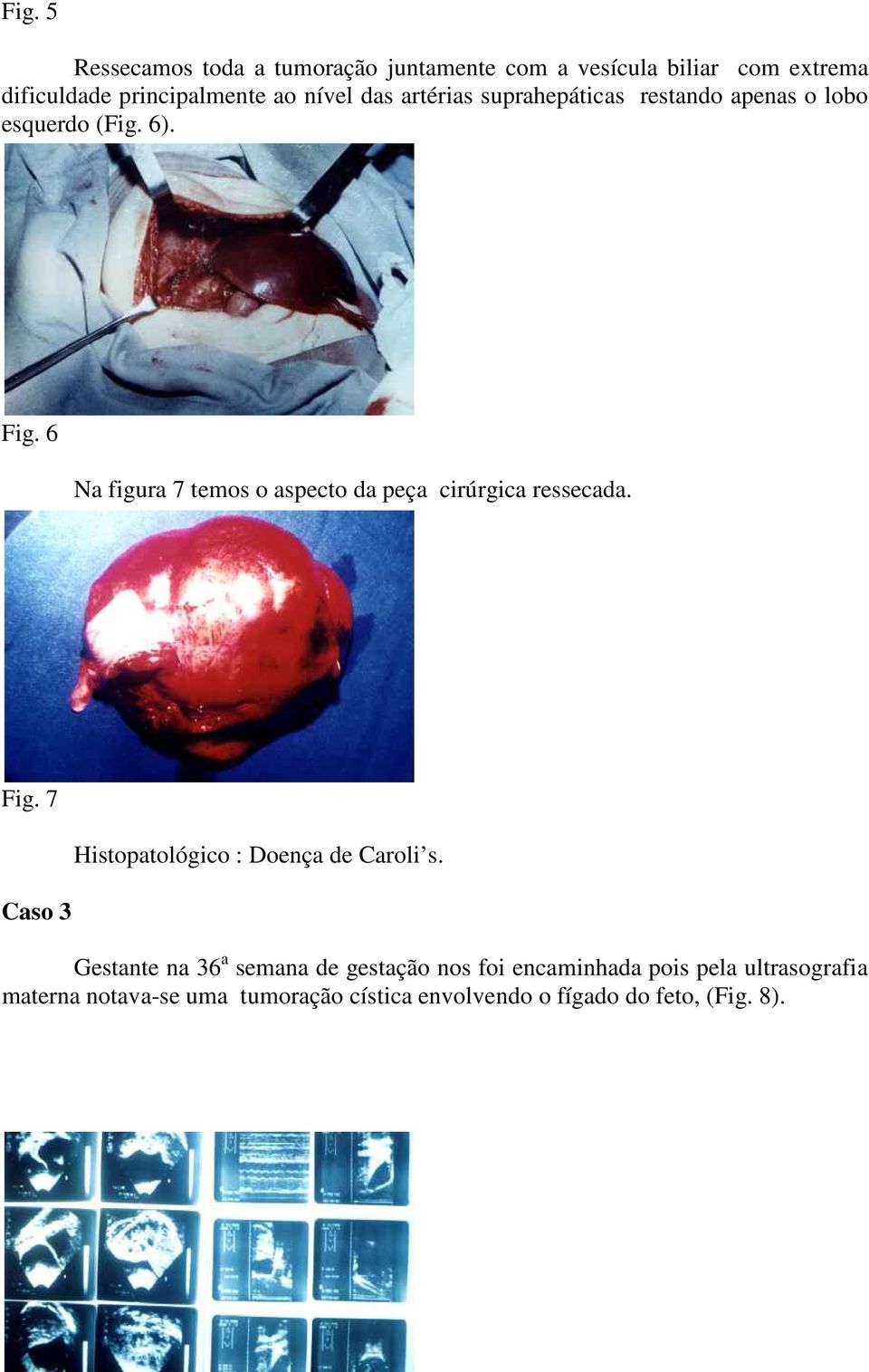 6 Na figura 7 temos o aspecto da peça cirúrgica ressecada. Fig. 7 Caso 3 Histopatológico : Doença de Caroli s.