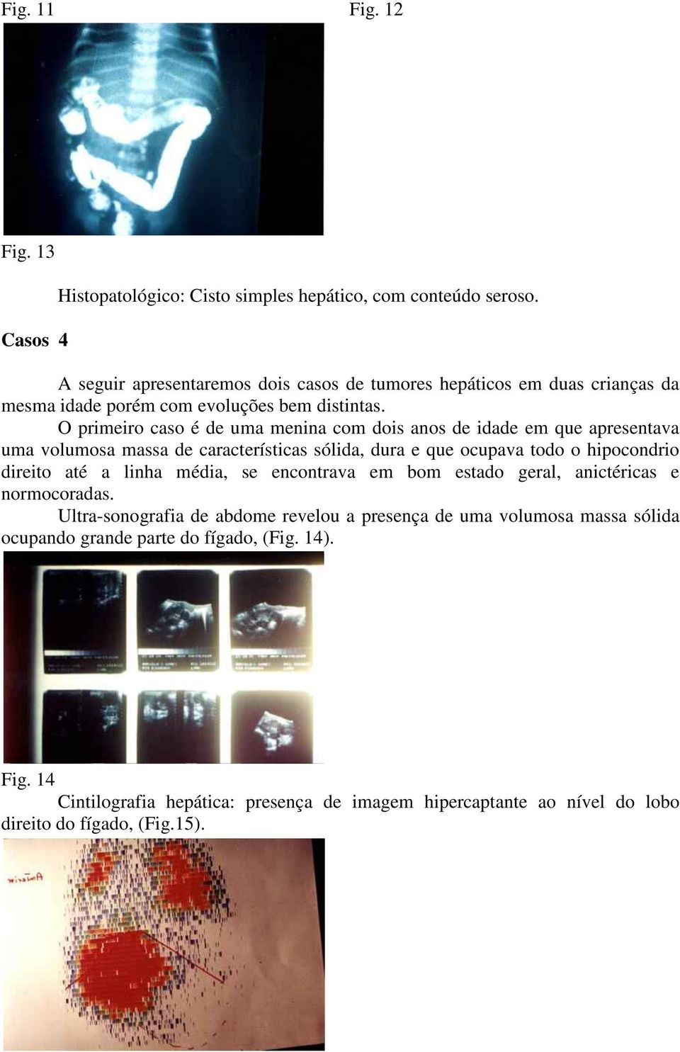 O primeiro caso é de uma menina com dois anos de idade em que apresentava uma volumosa massa de características sólida, dura e que ocupava todo o hipocondrio direito até a