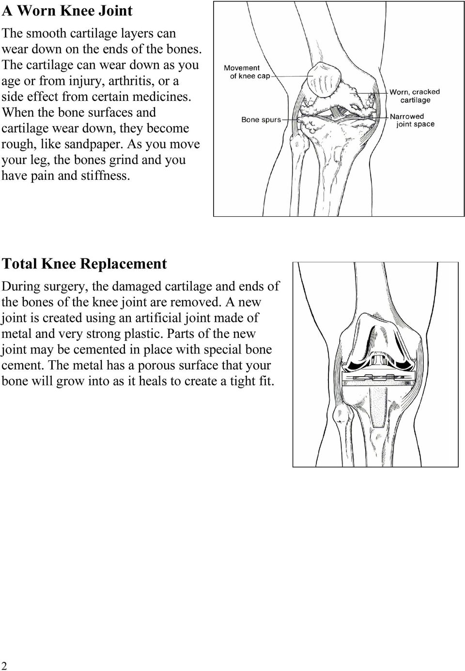 When the bone surfaces and cartilage wear down, they become rough, like sandpaper. As you move your leg, the bones grind and you have pain and stiffness.