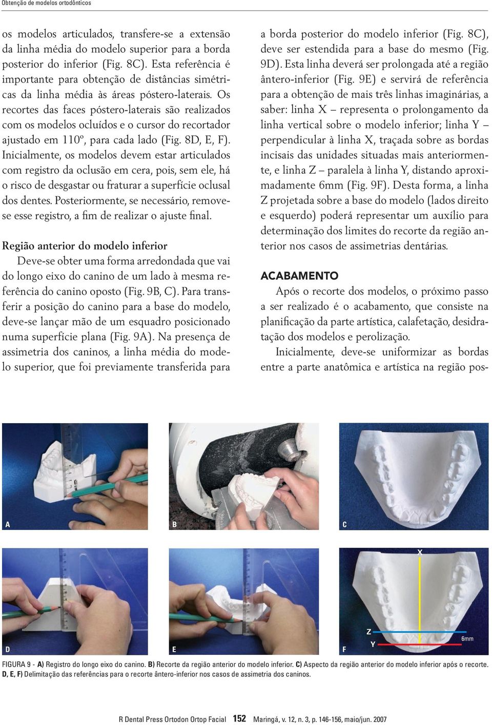 Os recortes das faces póstero-laterais são realizados com os modelos ocluídos e o cursor do recortador ajustado em 110º, para cada lado (Fig. 8D, E, F).