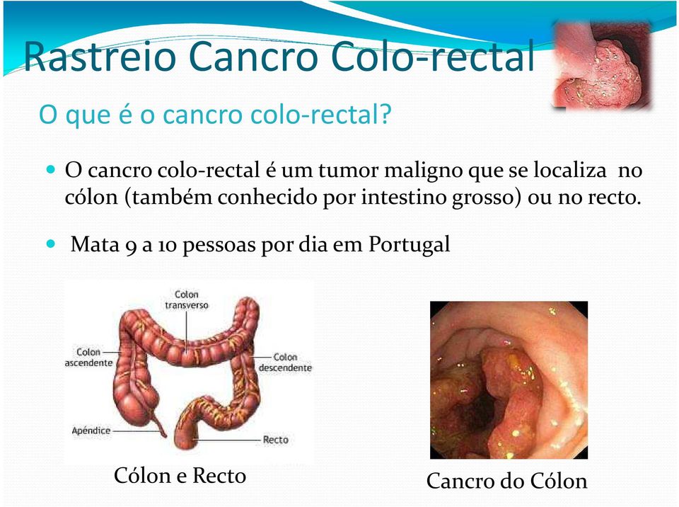 localiza no cólon (também conhecido por intestino