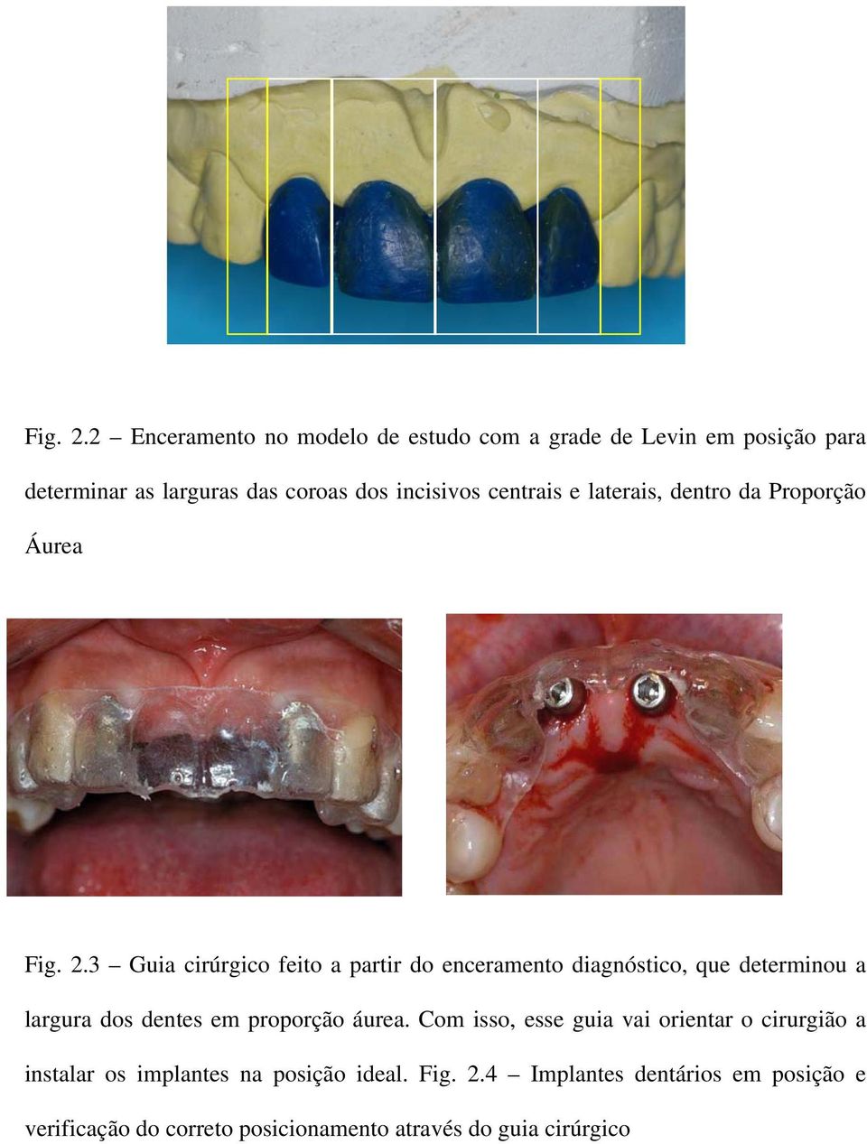 centrais e laterais, dentro da Proporção Áurea 3 Guia cirúrgico feito a partir do enceramento diagnóstico, que determinou