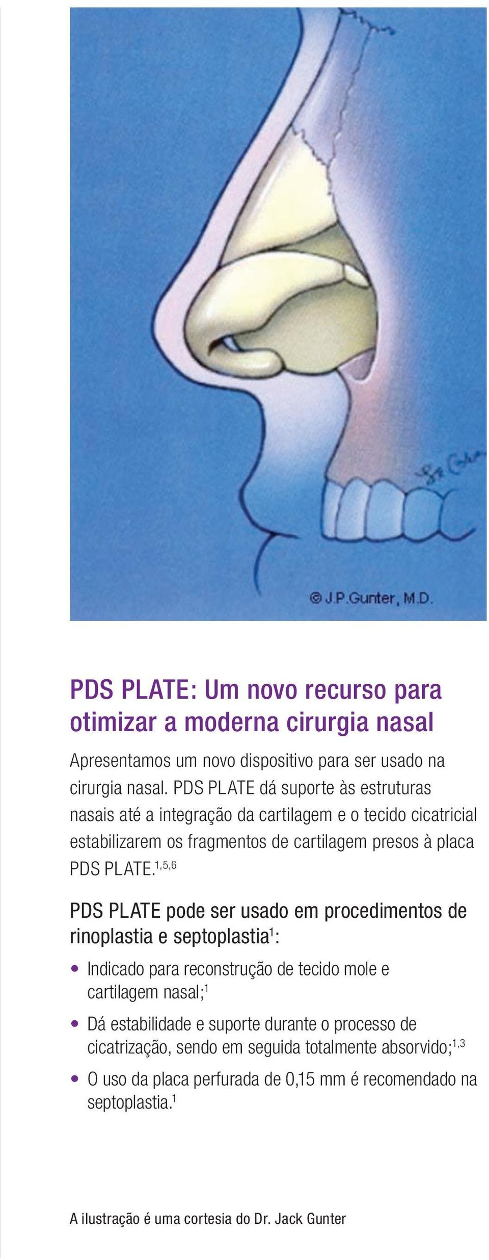 1,5,6 PDS PLATE pode ser usado em procedimentos de rinoplastia e septoplastia 1 : Indicado para reconstrução de tecido mole e cartilagem nasal; 1 Dá estabilidade e
