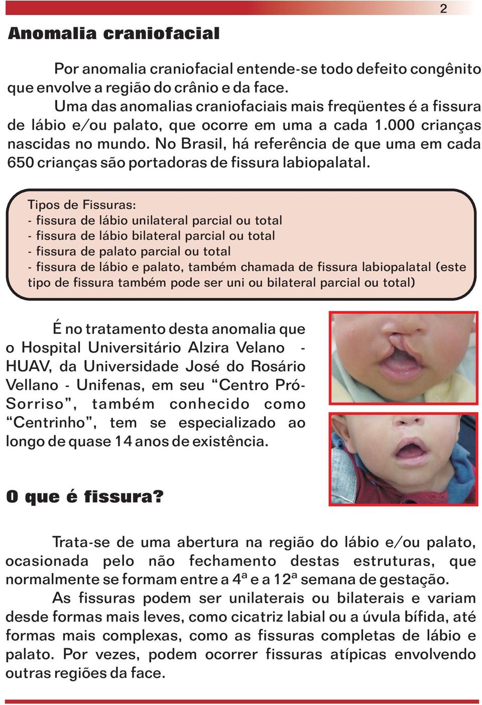 No Brasil, há referência de que uma em cada 650 crianças são portadoras de fissura labiopalatal.