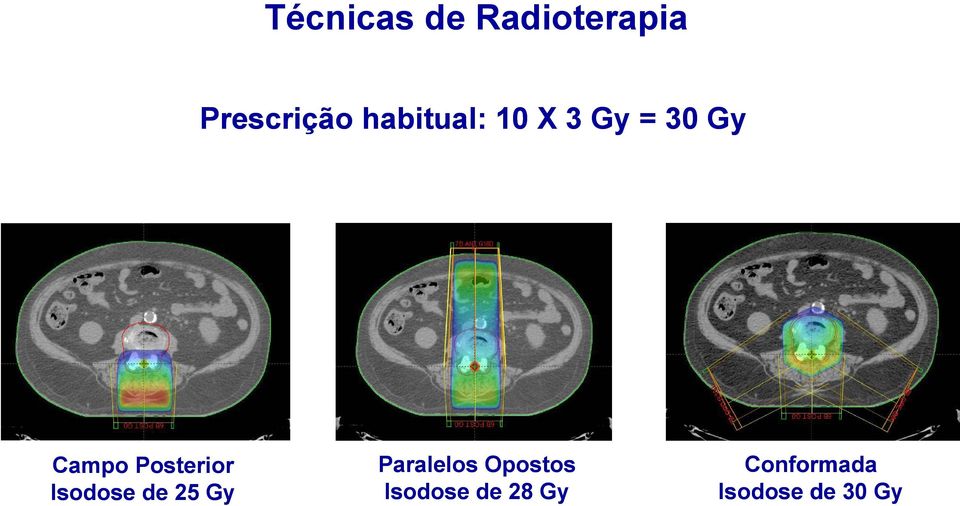 Posterior Isodose de 25 Gy Paralelos