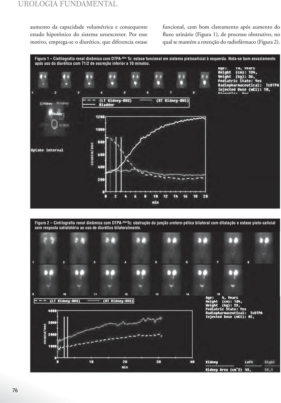 retenção do radiofármaco (Figura 2). Figura 1 Cintilografia renal dinâmica com DTPA- 99m Tc: estase funcional em sistema pielocalicial à esquerda.