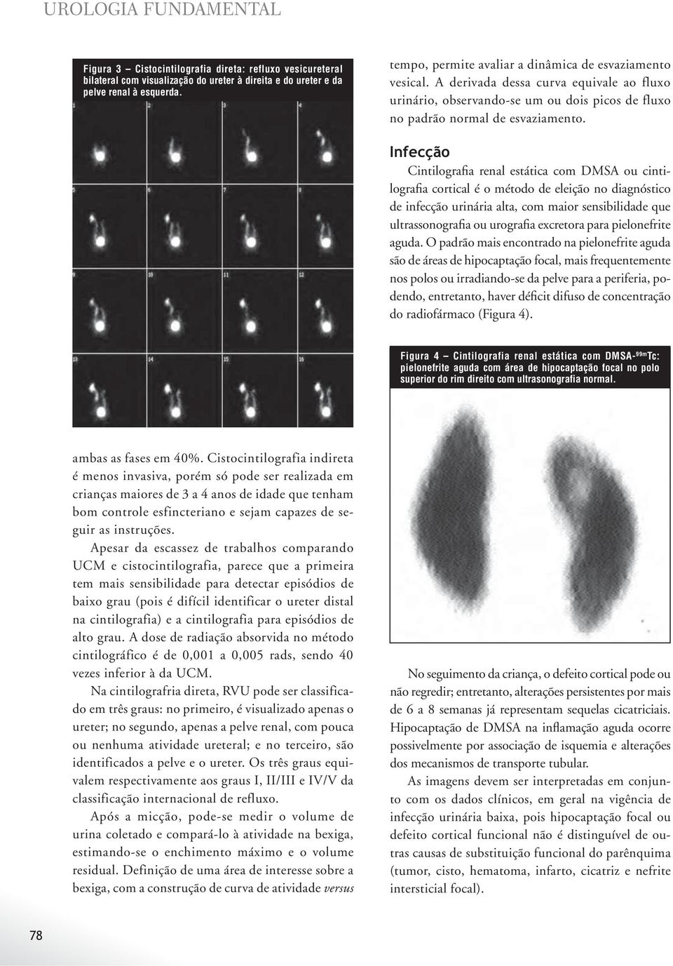 Infecção Cintilografia renal estática com DMSA ou cintilografia cortical é o método de eleição no diagnóstico de infecção urinária alta, com maior sensibilidade que ultrassonografia ou urografia