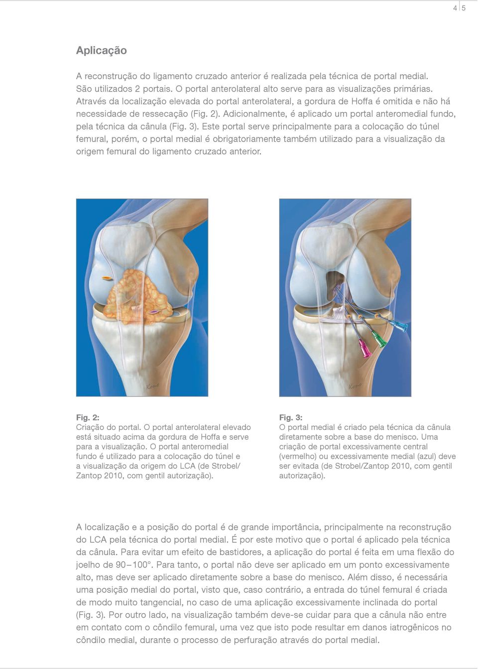 Adicionalmente, é aplicado um portal anteromedial fundo, pela técnica da cânula (Fig. 3).