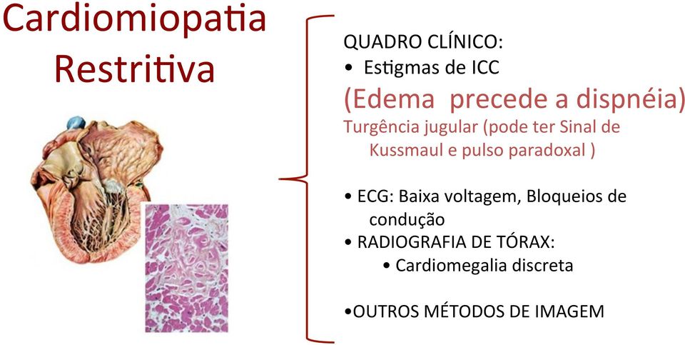 Kussmaul e pulso paradoxal ) ECG: Baixa voltagem, Bloqueios de