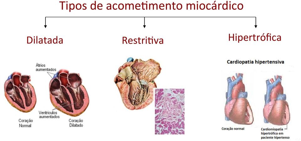 miocárdico