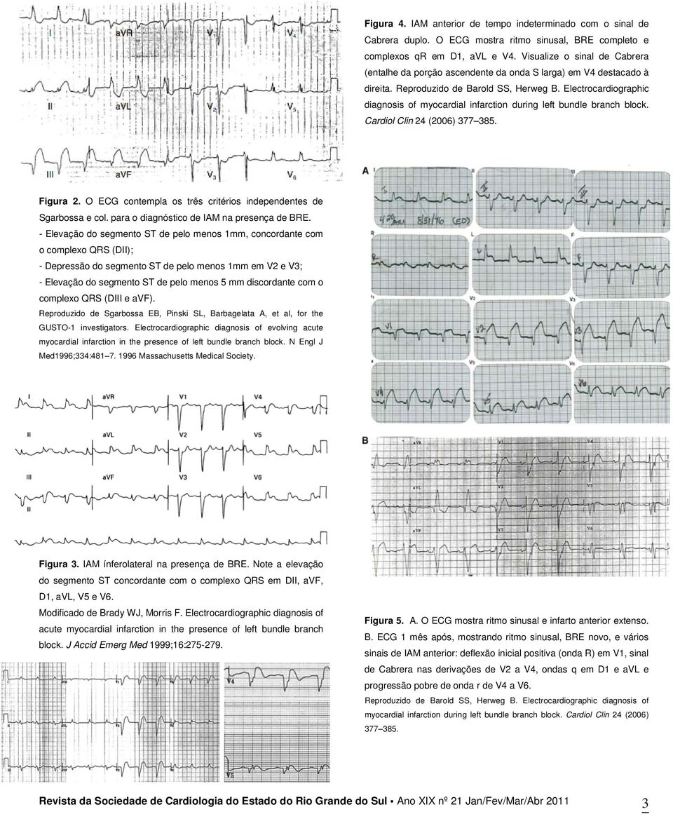 Electrocardiographic diagnosis of myocardial infarction during left bundle branch block. Cardiol Clin 24 (2006) 377 385. Figura 2. O ECG contempla os três critérios independentes de Sgarbossa e col.