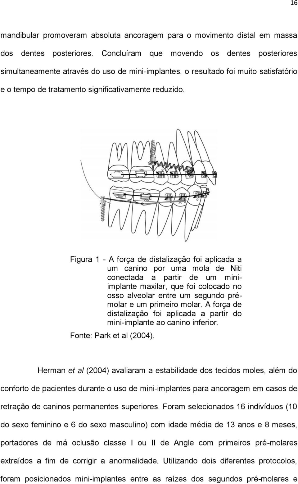 Figura 1 - A força de distalização foi aplicada a um canino por uma mola de Niti conectada a partir de um miniimplante maxilar, que foi colocado no osso alveolar entre um segundo prémolar e um